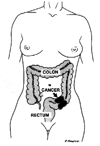 fistula