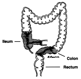 fistula