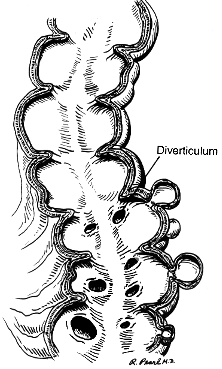 fistula